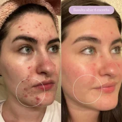 Meltdown Acne Oil -Deals Nude Flair Store 2579265 alt05