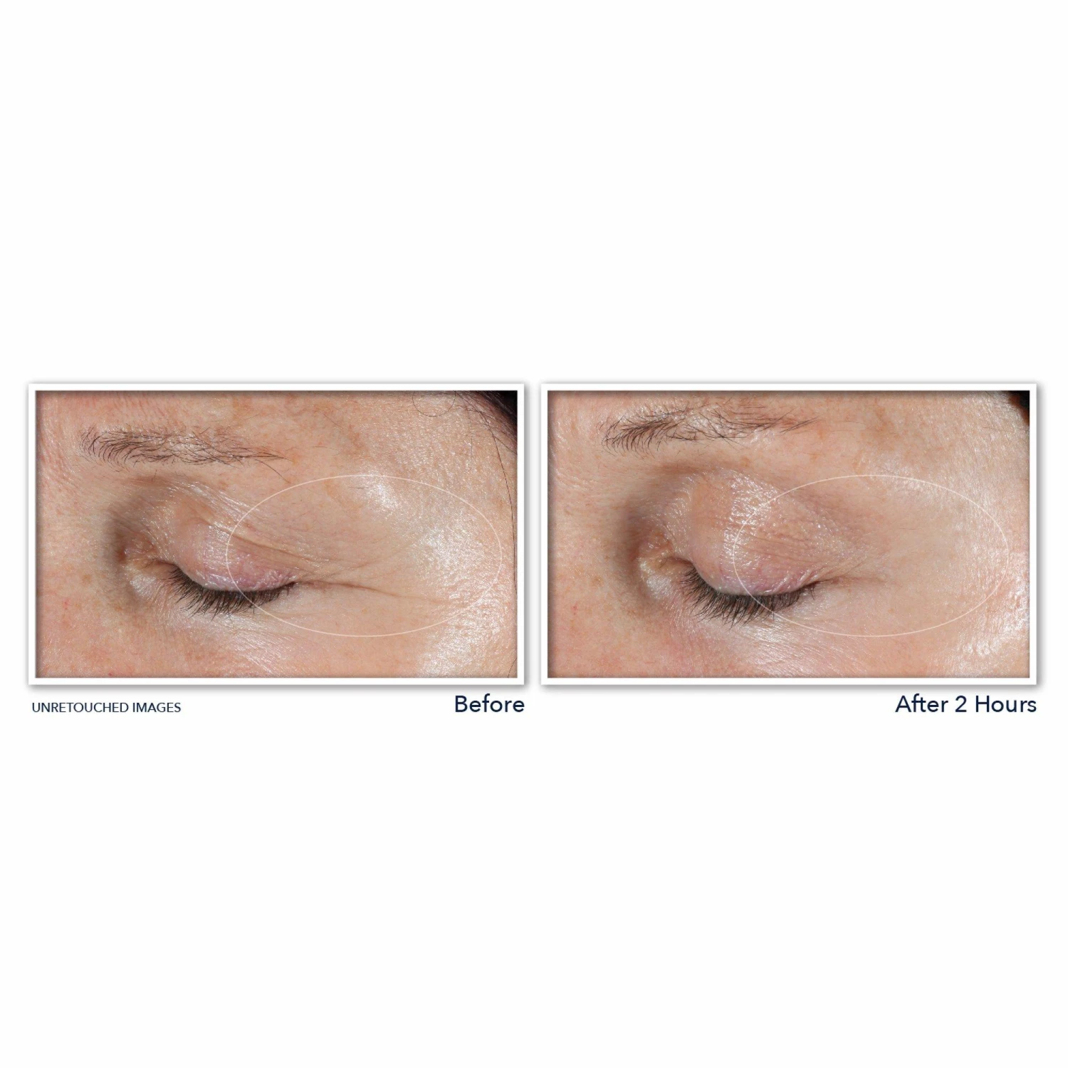 Roc Retinol Correxion Deep Wrinkle Targeted Patches 3 Roc Retinol Correxion Deep Wrinkle Targeted Patches - Image 3