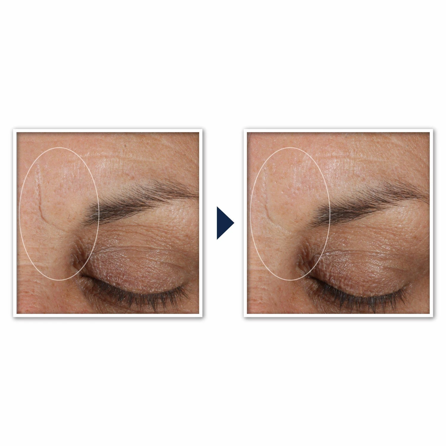 Roc Retinol Correxion Deep Wrinkle Targeted Patches 5 Roc Retinol Correxion Deep Wrinkle Targeted Patches - Image 5